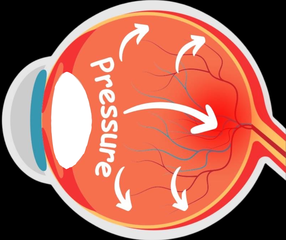 Retinal detached 8