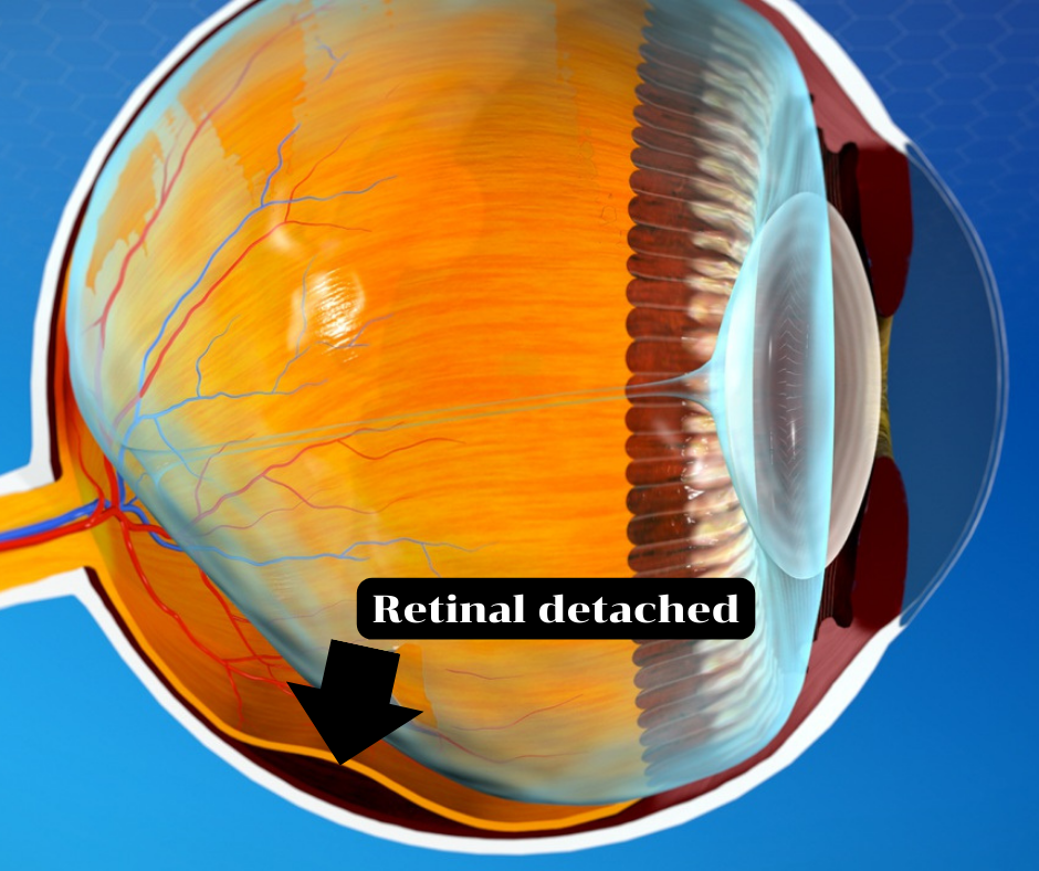 Retinal detached 3